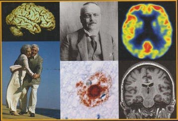 Atlas of Alzheimers Disease 9781841846842, Verzenden, Gelezen