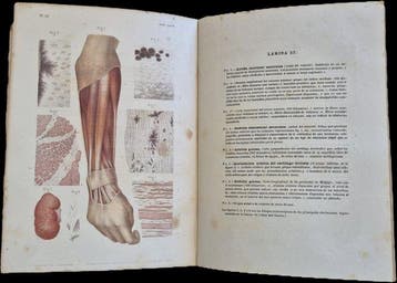 Dr. Étienne Lancereaux / Lackerbauer - Atlas de Anatomía, Antiek en Kunst