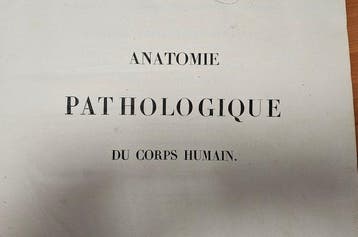 J. Cruveilhier - Anatomie pathologique du corps humain,