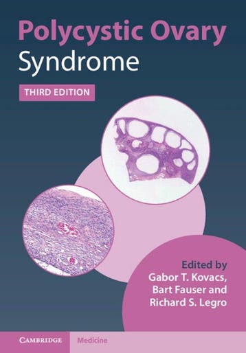 Polycystic Ovary Syndrome 9781108839334 Gabor T. Kovacs, Verzenden, Gabor T. Kovacs